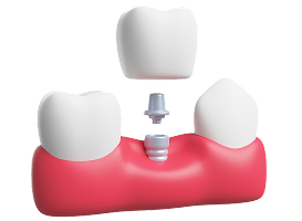 root-canal-treatment