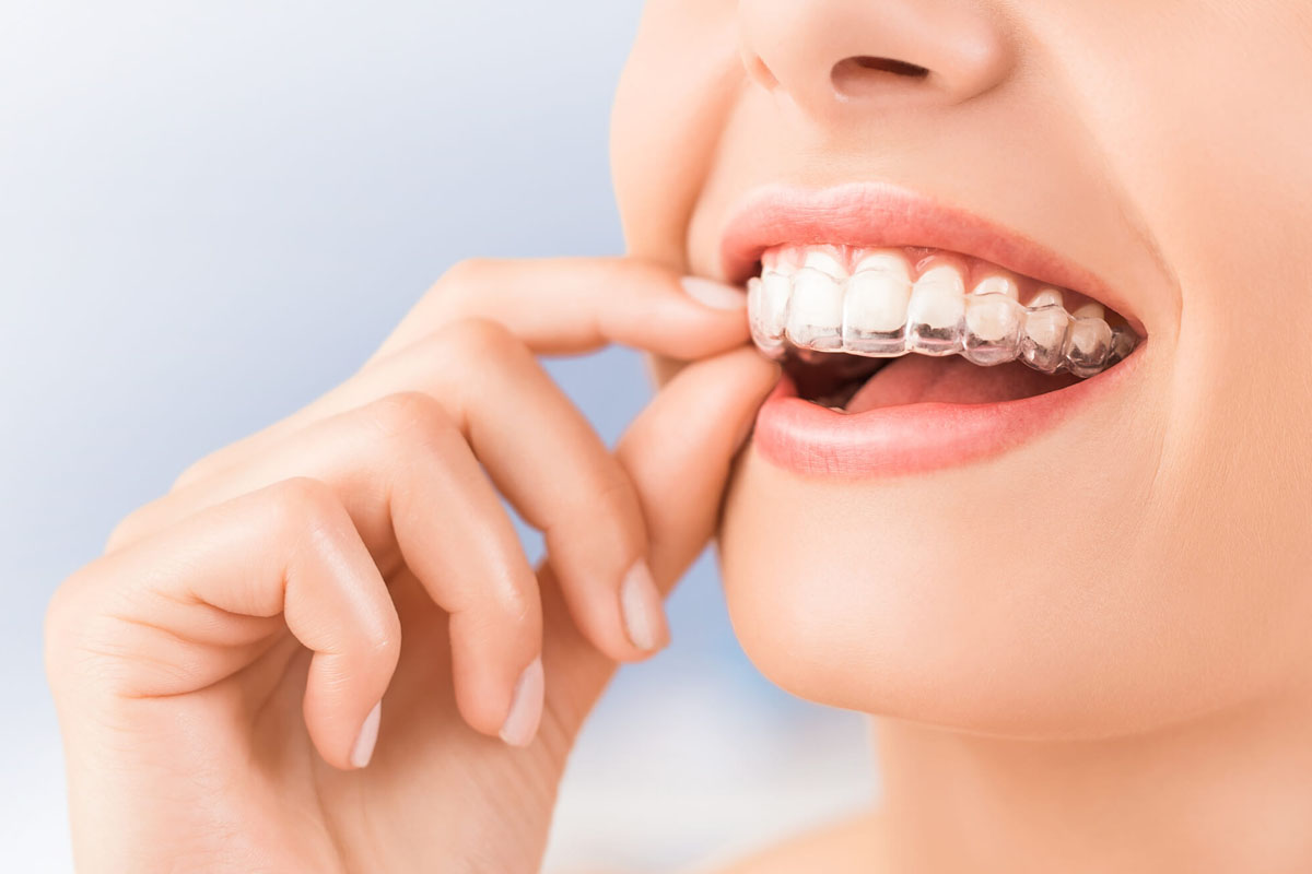 braces-aligners