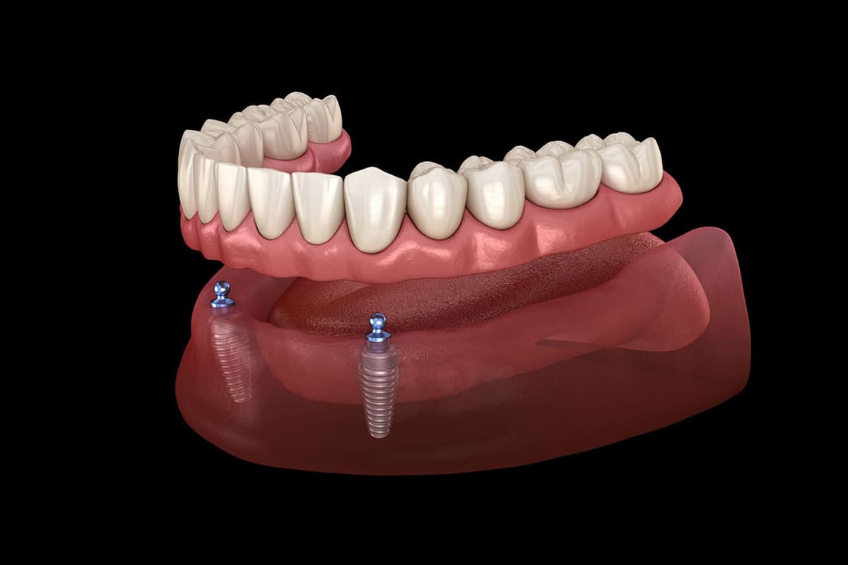 dental-implants-full-mouth-rehabilitation