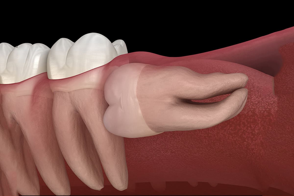 oral-surgery-wisdom-tooth-extraction