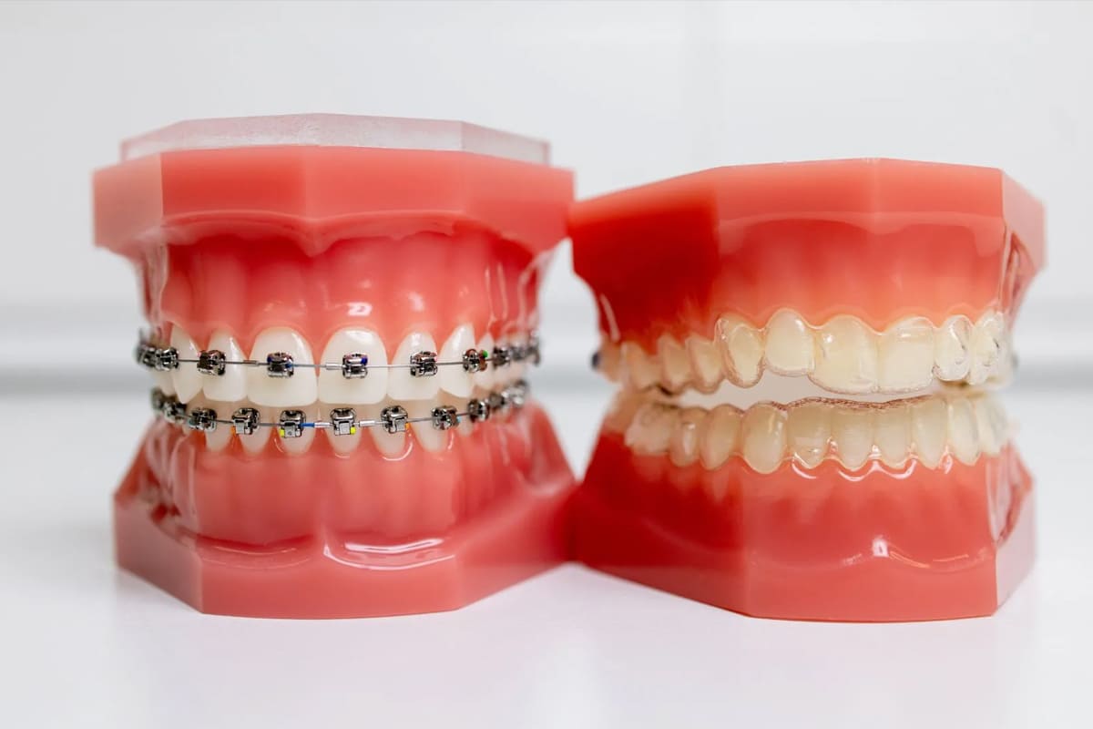 orthodontics-aligners